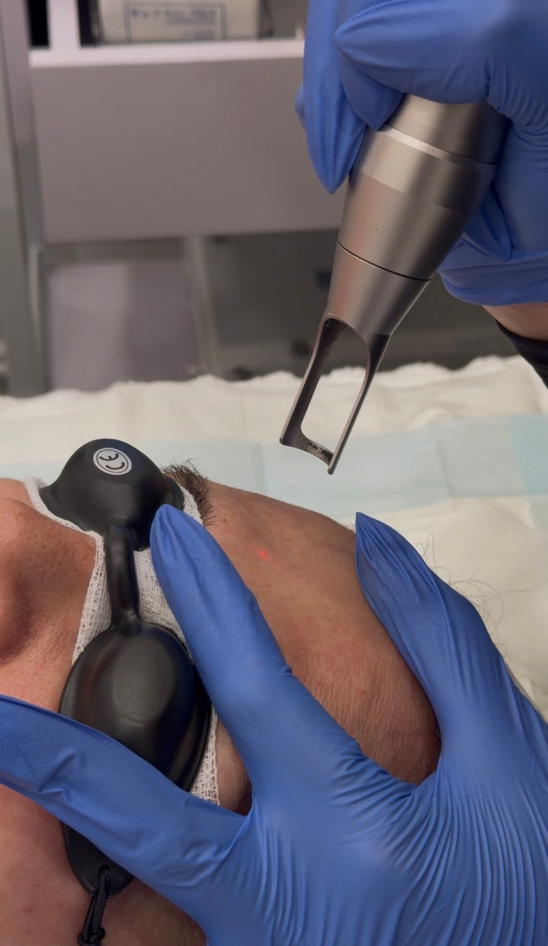 Laser Treatments
