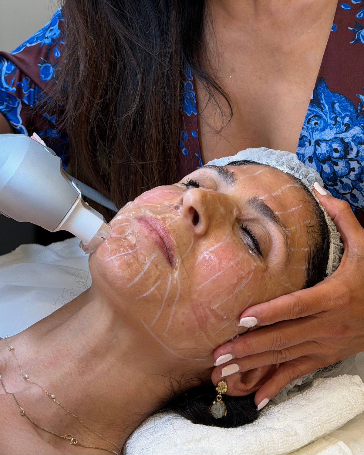 HIFU Facial Rejuvenation